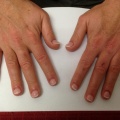 1B Mannelijke nagelbijter na de behandeling