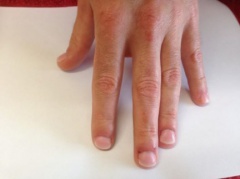 2B Mannelijke nagelbijter na de behandling met cover gel EV