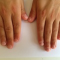 3B Mannelijke nagelbijter na de behandeling RV