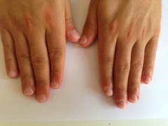 3B Mannelijke nagelbijter na de behandeling RV