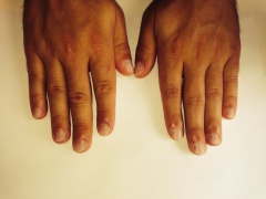 3C Mannelijke nagelbijter na 6 weken (1 arrangement) RV