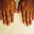 3C Mannelijke nagelbijter na 6 weken (1 arrangement) RV