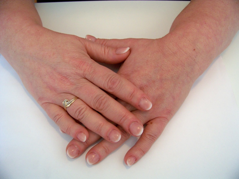 4b Minder extreme nagelbijter na de behandeling IV.JPG