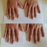 Gemiddelde nagelbijter SvD voor en na